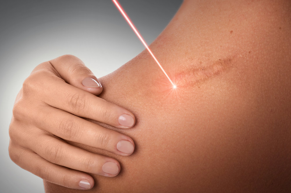 a laser removing a scar from a woman's shoulder