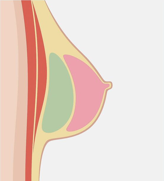 a diagram of an implant