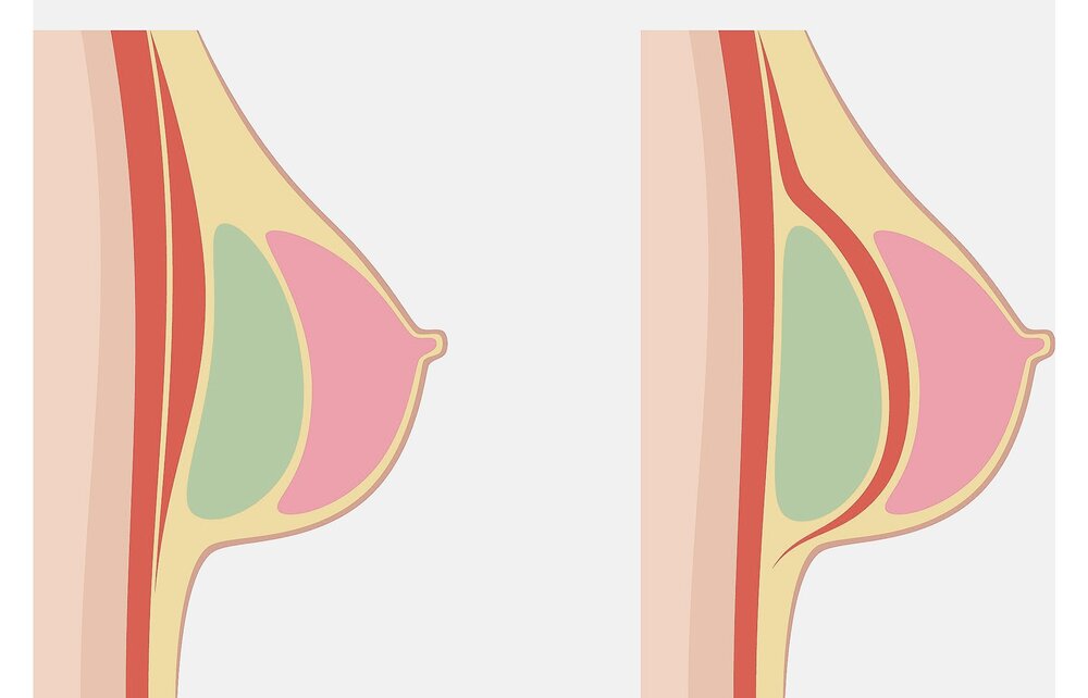 Which Breast Implant Placement Gives a Natural Appearance?