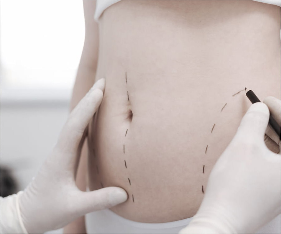 doctor marking woman's stomach with pencil