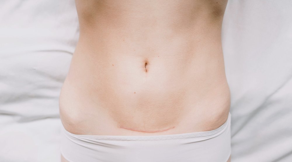 a woman's stomach with c-section scar
