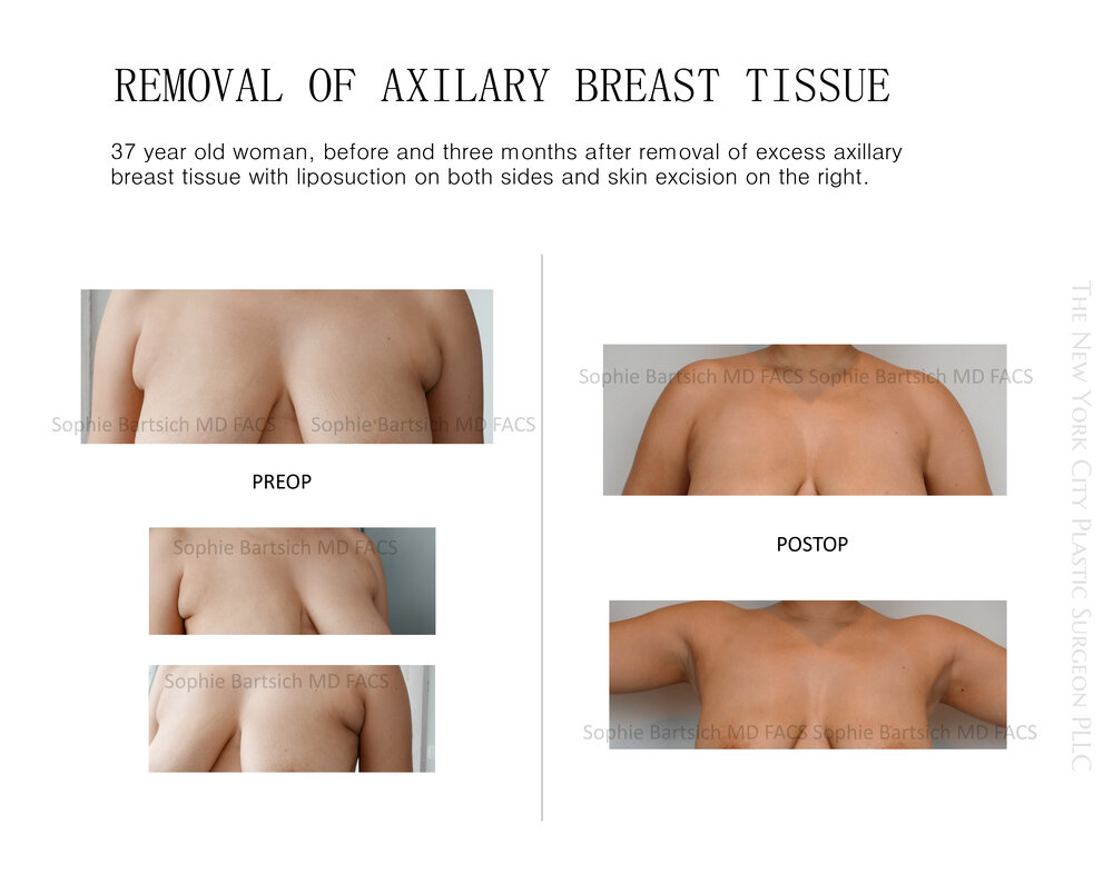 Axillary Armpit Breast and Fat Tissue Removal