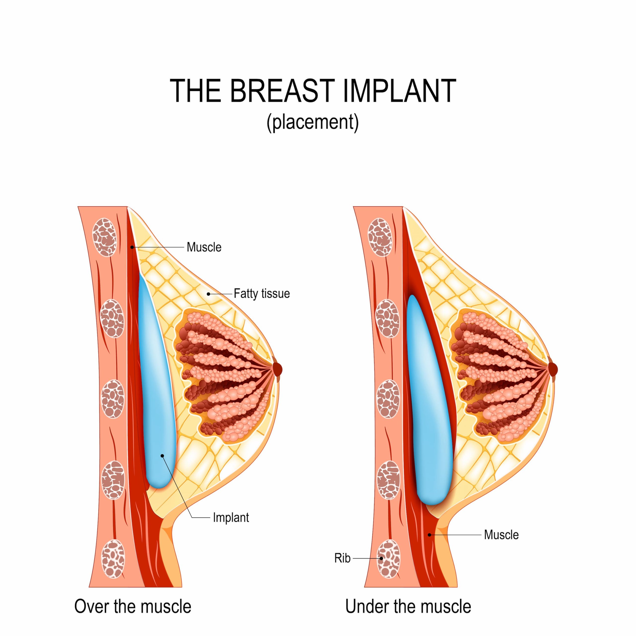 graphic showing breast implant placement