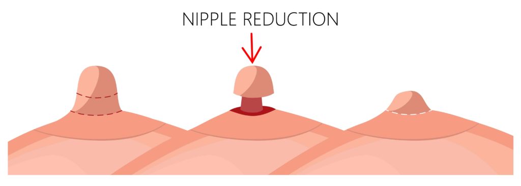 nipple reduction