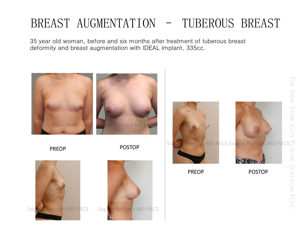 patient pre-op and post-op pictures