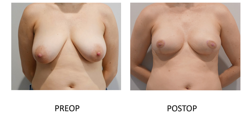 Before and after mastectomy reconstruction
