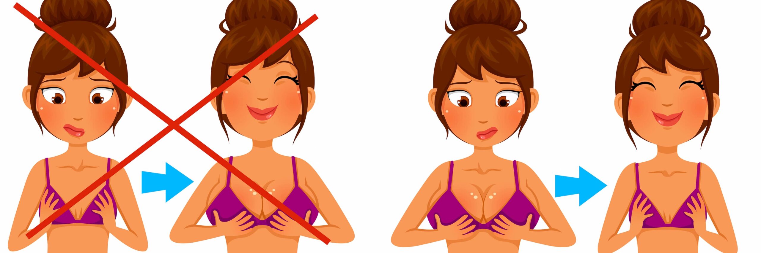 Illustration of breast reduction