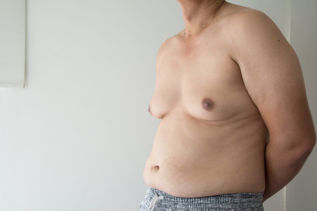 https://www.doctorsophie.com/wp-content/uploads/2023/11/gynecomastia-1-1024x683.jpg