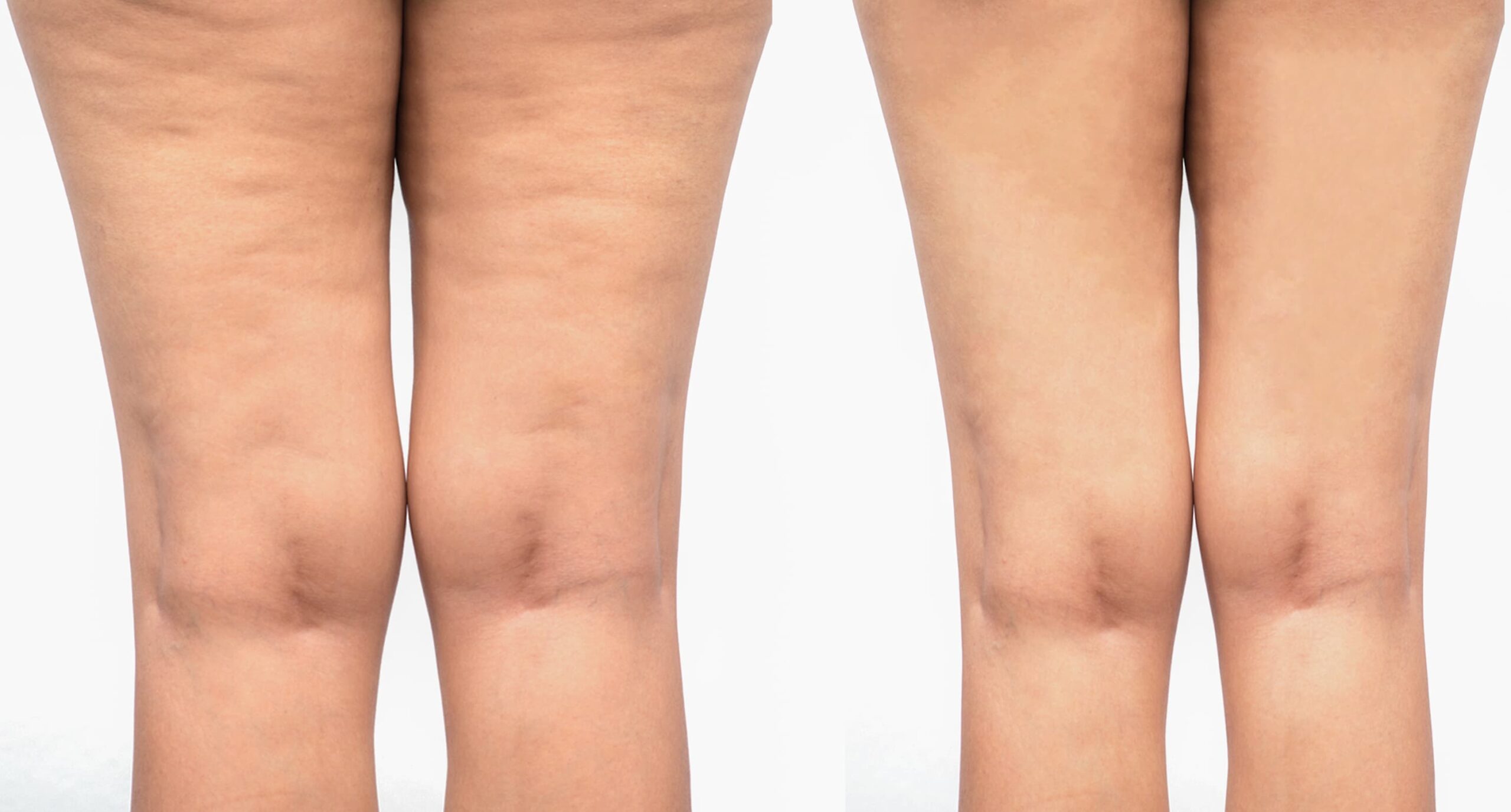 Side to side comparison of the back of a woman's legs.