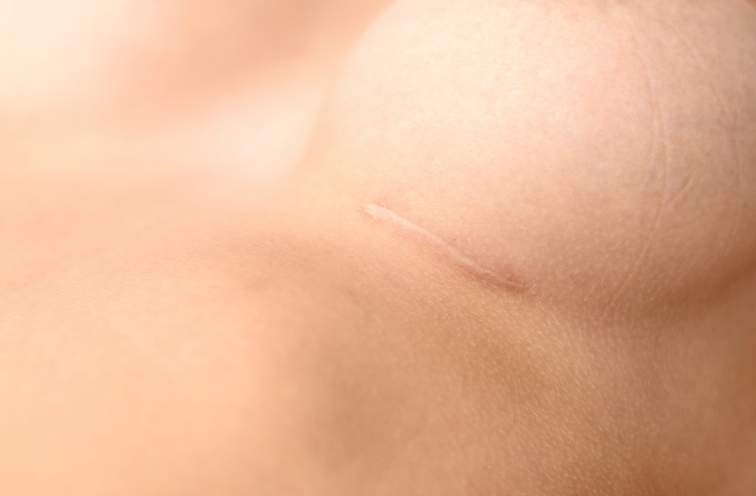 A scar under a woman's breast.