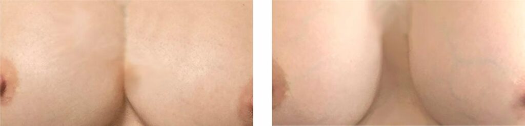 symmastia repair