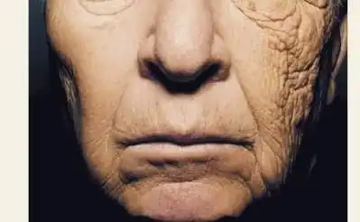 Facial sun damage caused by long-term UV exposure on one side of the face